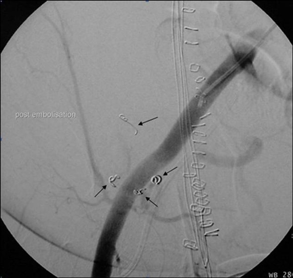 Coil embolization of inferior epigastric artery pseudoaneurysm after