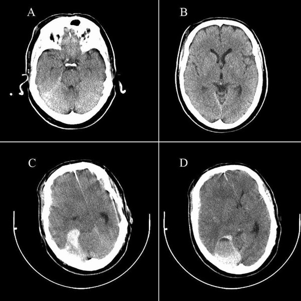 Delayed life-threatening subdural hematoma after minor head injury in a ...