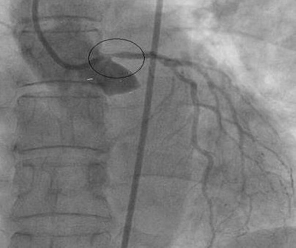 Bilateral coronary ostial disease following mediastinal irradiation: a