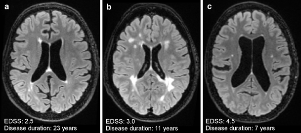44+ Multiple Sclerosis Normal Vs Abnormal Cervical Spine Mri Pictures