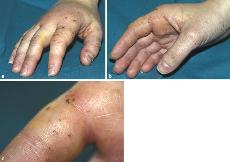 Chirurgische Behandlung von Bissverletzungen SpringerLink