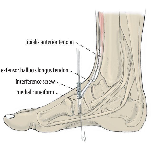 Extensor hallucis longus-transfer for tibialis anterior tendon rupture