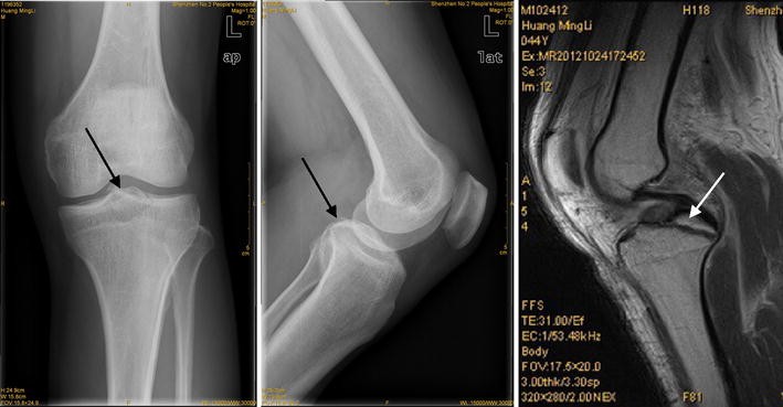 Treatment of tibia avulsion fracture of posterior cruciate