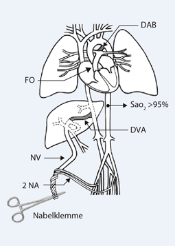 Reanimation des Neugeborenen | SpringerLink