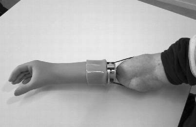 amputation fig rehabilitation