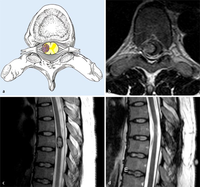 Diagnostik und Therapie der spinalen vaskulären Malformationen