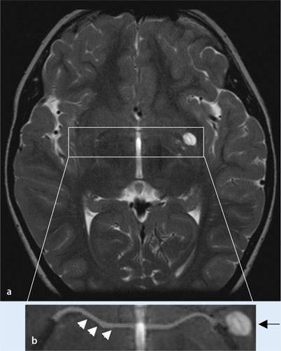 Klinische Bedeutung Normaler Und Erweiterter Virchow Robin Räume Klinische Bedeutung normaler und erweiterter Virchow-Robin-Räume