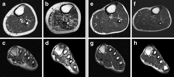 Accelerated atrophy of lower leg and foot muscles—a follow ...