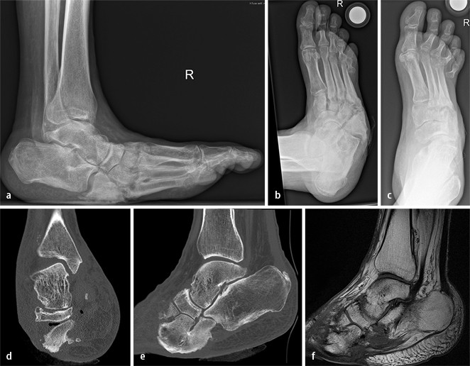 Komplexe Rekonstruktionen bei Charcot-Arthropathie mittels ...
