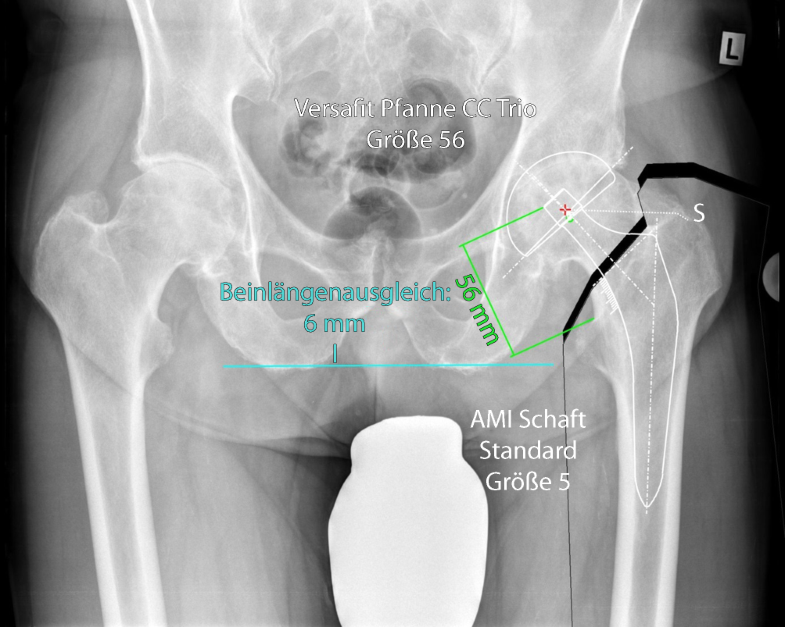 Die minimalinvasive AMISTechnik zur Implantation von Hüftprothesen SpringerLink