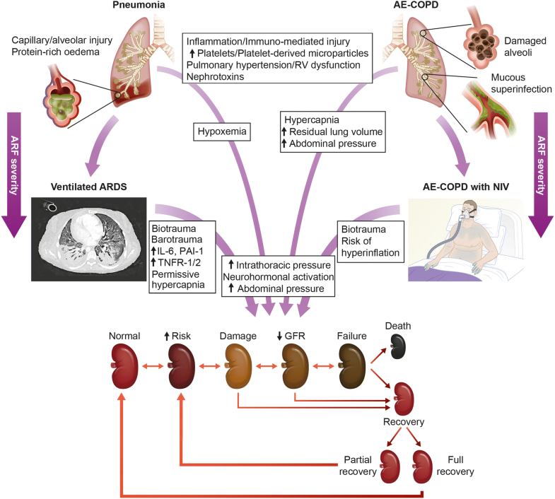 Lungkidney interactions in critically ill patients consensus report