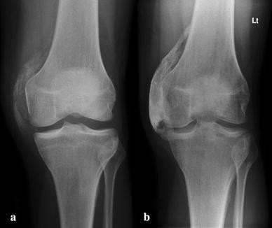 Good result after surgical treatment of Pellegrini-Stieda ...