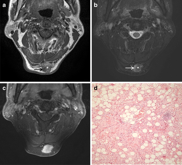 spindle cell lipoma spindle cell lipoma
