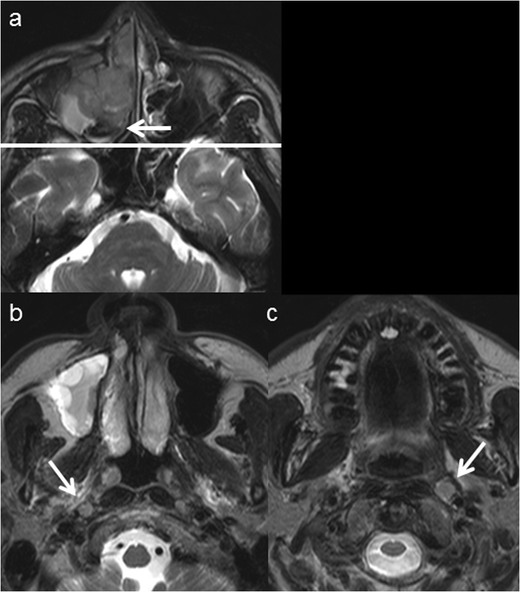 Incidence Of Abnormal Retropharyngeal Lymph Nodes In Sinonasal