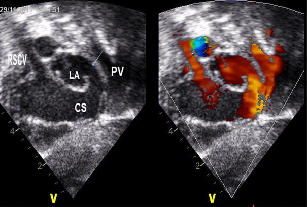 Total Anomalous Pulmonary Venous Connection To The Unroofed Coronary 