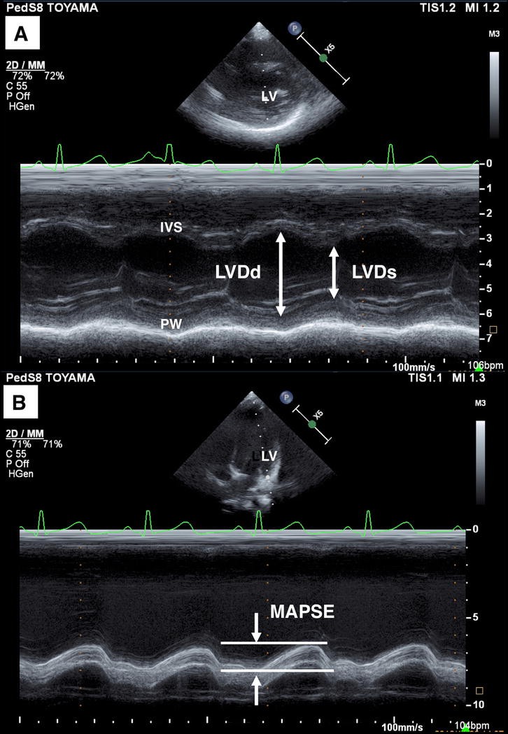 Zscore of Mitral Annular Plane Systolic Excursion is a Useful