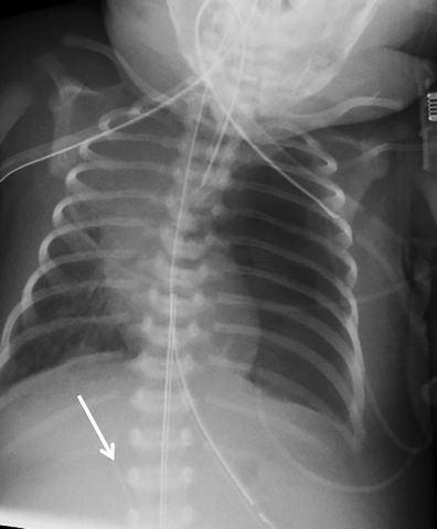 Umbilical Venous Catheter Malposition And Errors In Interpretation In 