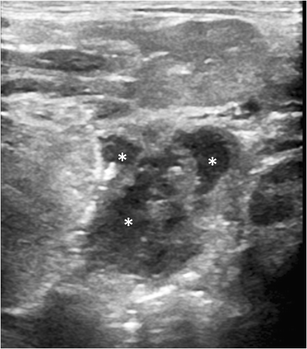 Tonsil ultrasound: technical approach and spectrum of pediatric ...