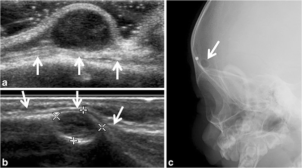 Sonography of pediatric superficial lumps and bumps: illustrative