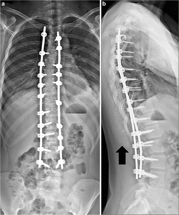 Pediatric spine imaging post scoliosis surgery SpringerLink