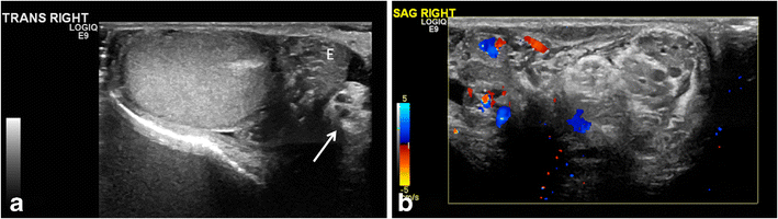 Testicular torsion with preserved flow: key sonographic features and ...