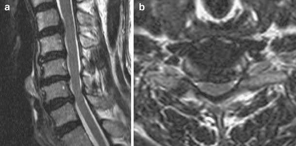 Cervical interlaminar epidural steroid injection for neck ...