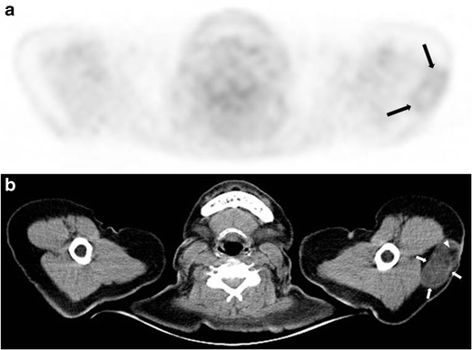 Encapsulated fat necrosis mimicking subcutaneous liposarcoma ...