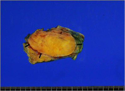 Encapsulated fat necrosis mimicking subcutaneous liposarcoma ...