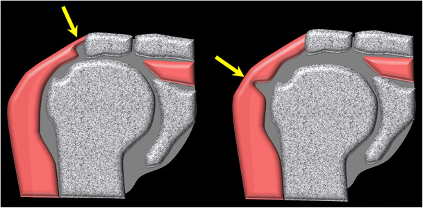 The deltoid, a forgotten muscle of the shoulder | SpringerLink