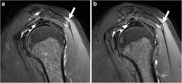 Enthesitis ankylosing spondylitis picture