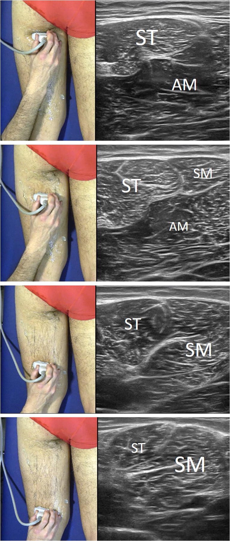 Sonographic landmarks in hamstring muscles | SpringerLink