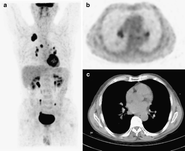 18F-FDG PET/CT in mediastinal lymph node staging of non-small-cell lung