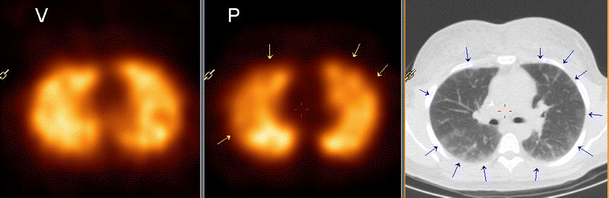 SPECT/CT and pulmonary embolism | SpringerLink