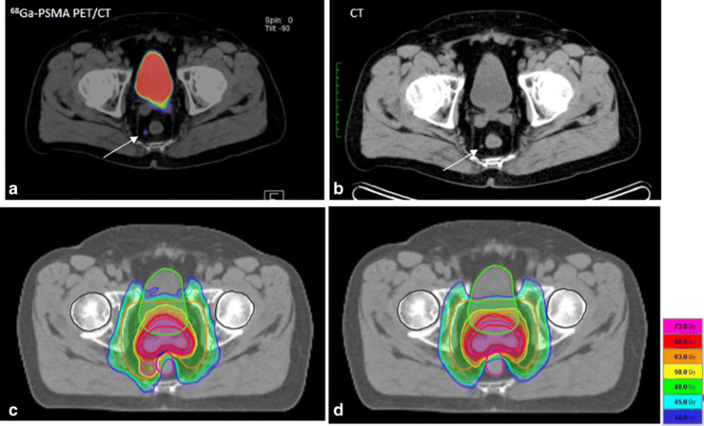 68Ga-PSMA-11 PET/CT: a new technique with high potential for the ...