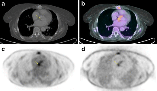 Assessment of the diagnostic accuracy of 18F-FDG PET/CT in prosthetic ...
