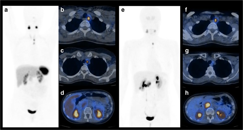 68Ga-DOTANOC and 18F-DOPA PET/CT: a site-specific approach to the ...