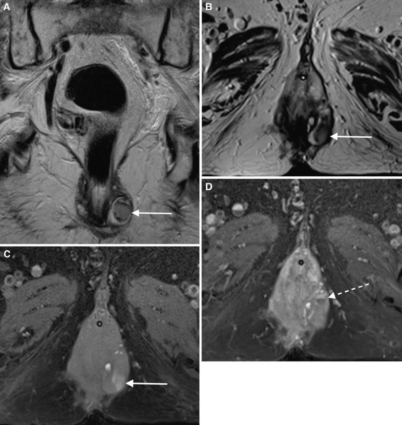 Female perineal diseases: spectrum of imaging findings | SpringerLink