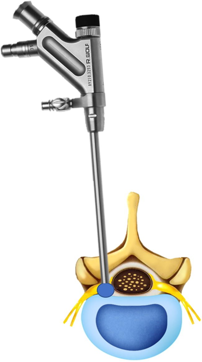 Endoscopic spine discectomy indications and SpringerLink