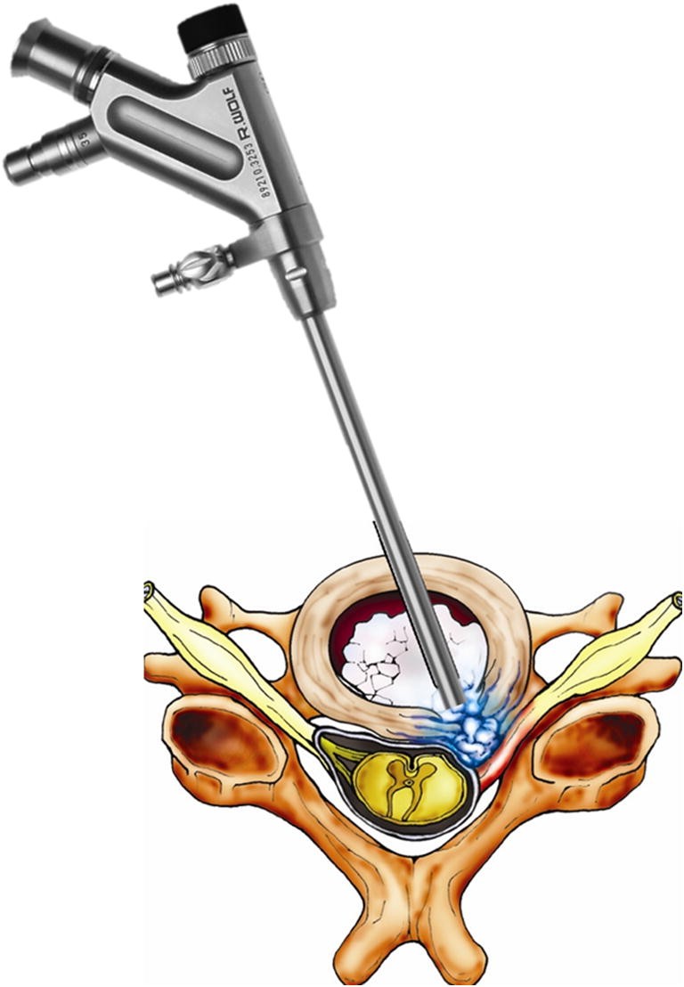 Endoscopic spine discectomy indications and SpringerLink