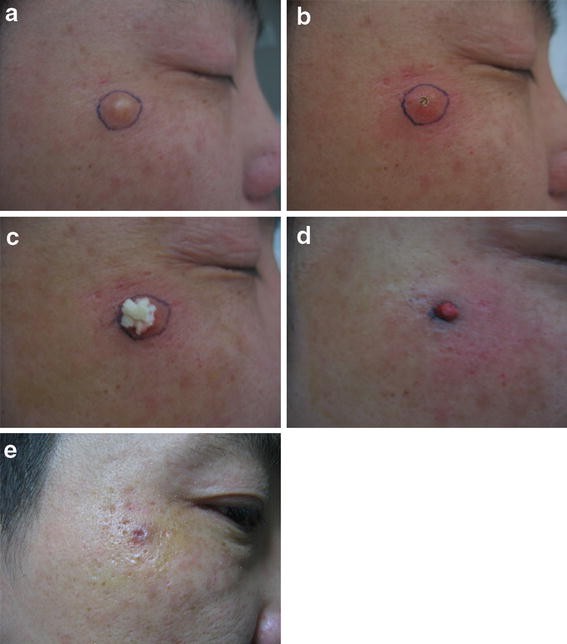 A New Procedure for Treating a Sebaceous Cyst Removal of