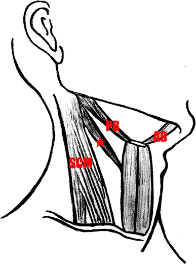 Duplicated posterior belly of digastric muscle and absence of omohyoid