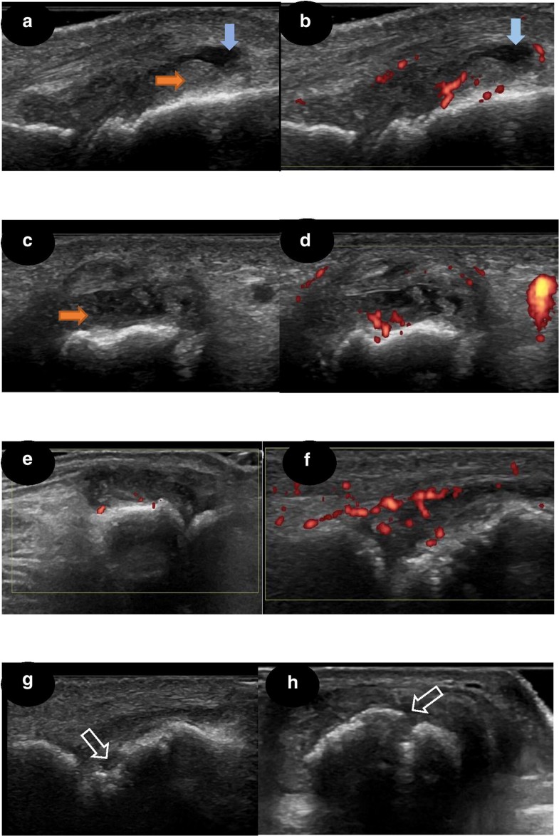 Real benefits of ultrasound evaluation of hand and foot synovitis for ...