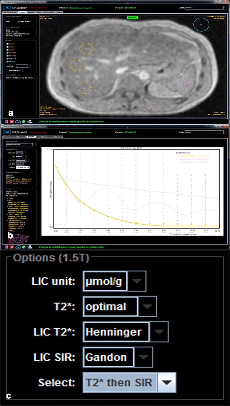 Practical guide to quantification of hepatic iron with MRI SpringerLink