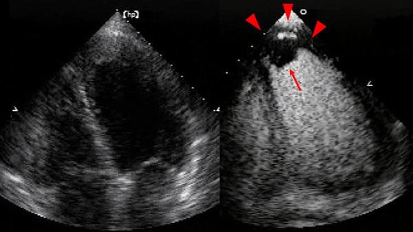 Contrast echocardiography for the diagnosis of left ventricular thrombus in anterior myocardial ...