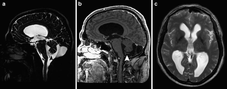 The clinical spectrum of Blake’s pouch cyst: report of six illustrative ...