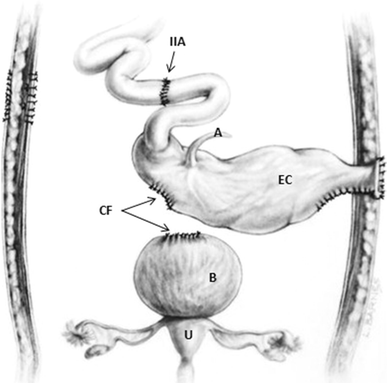 The “rescue operation” for patients with cloacal exstrophy and its ...