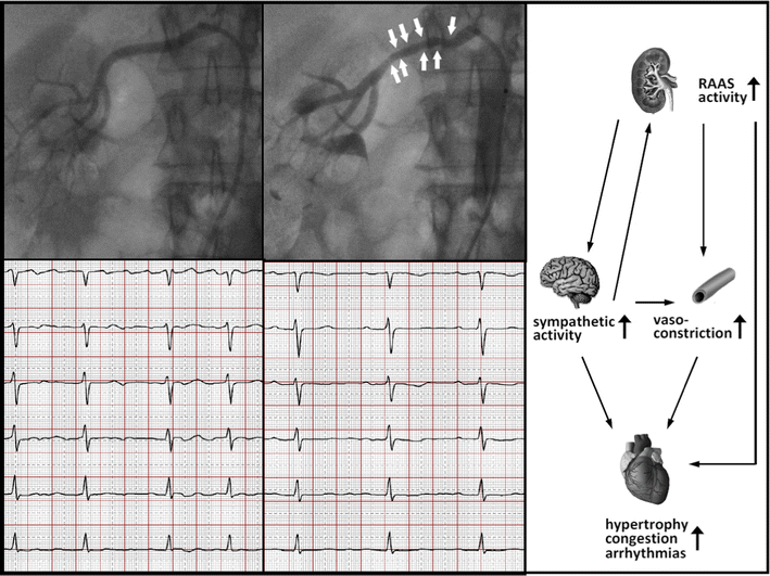 Renal artery ablation instead of pulmonary vein ablation in a