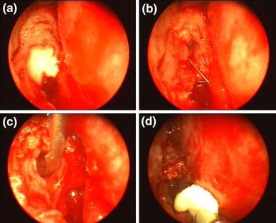endoscopic dcr stents