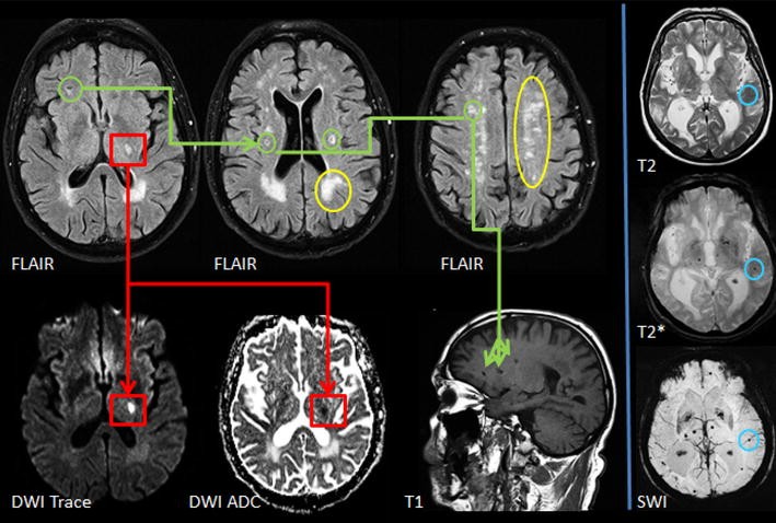 Cerebral small vessel disease, cognitive reserve and cognitive