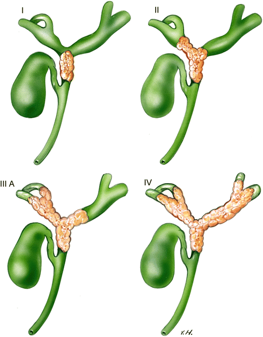 Modern work-up and extended resection in perihilar cholangiocarcinoma ...